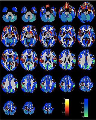 High-Order Visual Processing, Visual Symptoms, and Visual Hallucinations: A Possible Symptomatic Progression of Parkinson's Disease